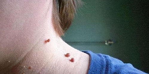 脖子上不断长出“小肉球”，可以用手抠掉吗是HPV感染引起的吗(脖子上的小肉球能剪吗)