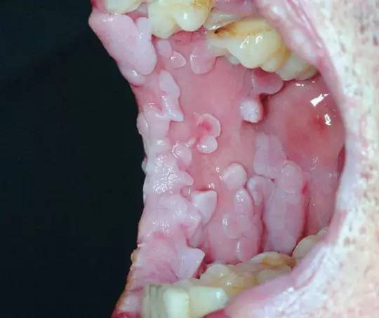 尖锐湿疣 hpv 性传播疾病的口腔表征知多少