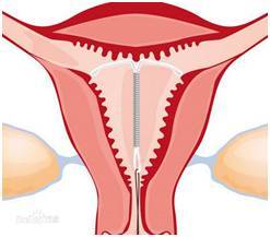 避孕环下移的原因是什么什么样的避孕环好