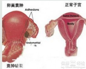 卵巢囊肿长在什么位置