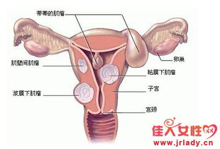 子宫肌瘤哪些东西不能吃呢(子宫肌瘤哪些东西不能吃呢女性)