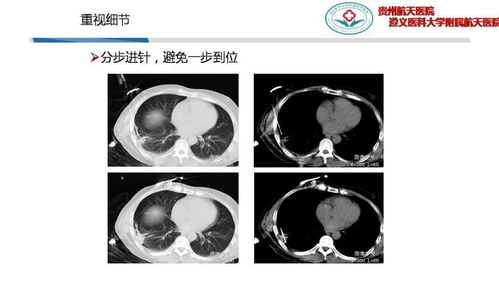 经皮肺穿刺活检术的临床应用及并发症处理