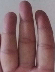 我的手指骨头长得是弯曲的和歪的,是遗传我爸的,手指骨头长得弯曲和歪就是因为遗传 有别的原因吗 