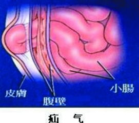 花甲老爷爷,小肠容易 逃跑