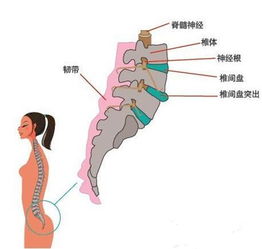 如何进行治疗腰间盘突出最具疗效