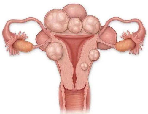 卵巢囊肿 盆腔积液 宫颈囊肿 揭秘5个 吓人 的妇科问题
