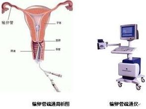 输卵管通水