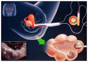 试管囊胚移植，试管婴儿的囊胚移植是怎样的过程