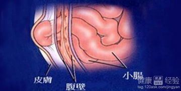 疝气手术有危险性吗