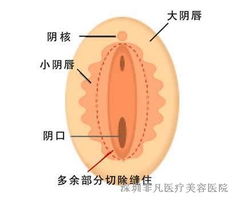 小阴唇整形安全吗 深圳做阴唇整形效果价格介绍 