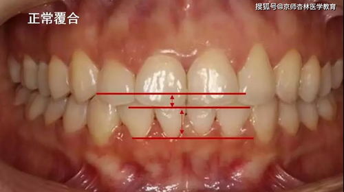 深覆合 深覆盖 两种龅牙有什么不同