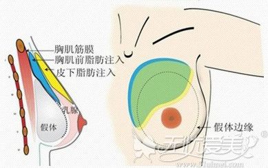 假体隆胸手术拆线后是不是需要每天都按摩