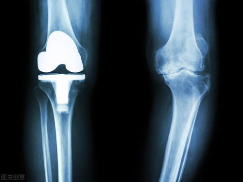 膝关节置换术有危险吗 人工膝关节能维持多久 答案全在这里了
