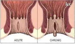 肛裂为什么反复发作