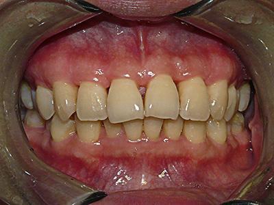 全中国约一半的人都存在牙龈萎缩,你也存在吗
