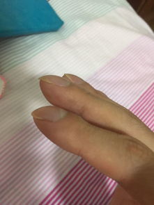为什么无名指指甲长得最快 而且指甲缝里有臭味,其他的就没有 