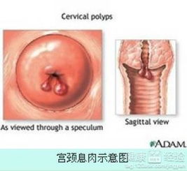 宫颈息肉出血治疗方法