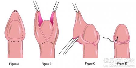 宝宝小鸡鸡包皮过长怎么办