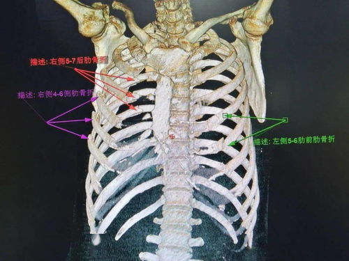 肋骨骨折固定方法图片 搜狗图片搜索