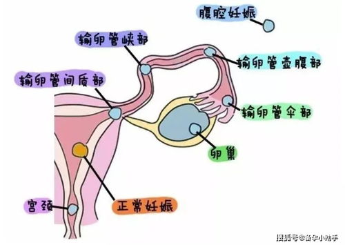 早孕试纸显示 两条杠 ,为什么医生却说没怀孕