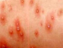 出水痘有什么症状 水痘发病原因有什么危害如何预防 
