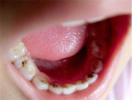 蛀牙真是被 虫子 蛀坏的吗 医生告诉你, 虫子 到底有多厉害