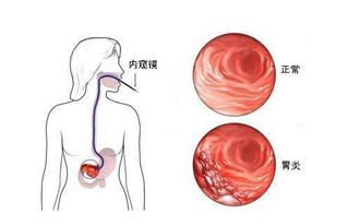胃病最严重的三个征兆(警惕胃病到胃癌的五个征兆)