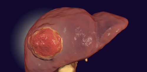 肝脏结节边界欠清是恶性肿瘤吗