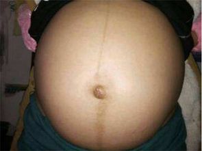 为何有些孕妈的肚脐是凸出来的 