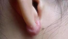耳洞反复发炎 这几步护理方法你掌握了吗