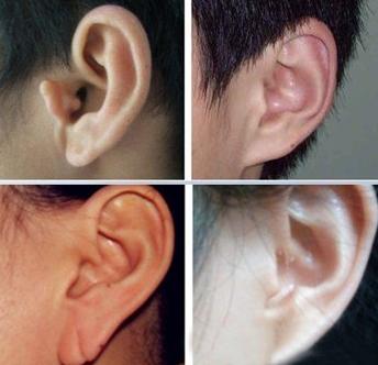 什么是附耳 治疗这种耳部问题可以这样做