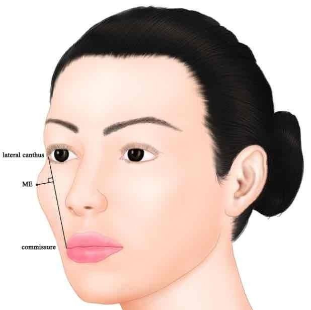 仰脸女子外八脚,人中有痣颧骨高 ,古人忠告 这四种人不能娶