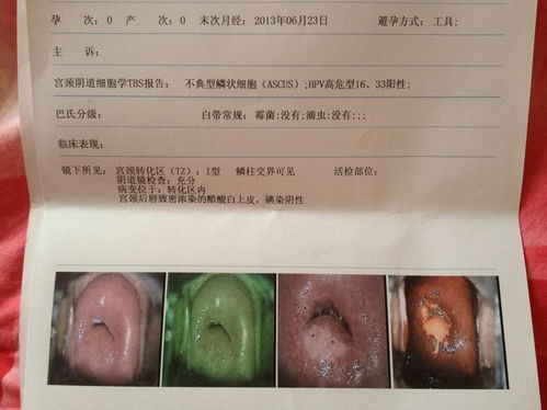 hpv 阳性 体检hpv阳性.保险会查得到吗 