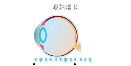 为什么已经成年了,近视度数还在增长