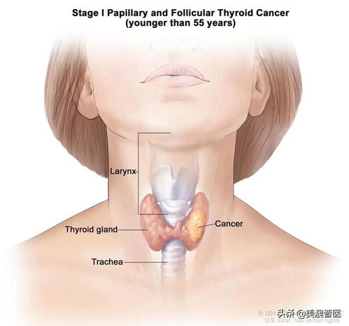 正确补充碘对甲状腺很重要 关于碘补充的十问十答