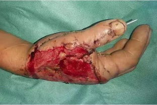 男子被抛光机 咬 手致大量软组织碎裂,金乡县医院手足外科3次手术完美修复
