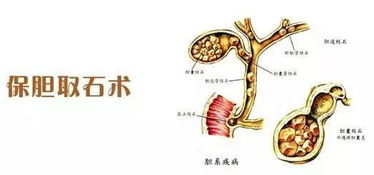 保胆取石能保住所有胆囊结石患者的胆囊吗