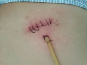 前天手术切除了一个脂肪瘤,这是手术缝合的图片,请问是这是美容针吗 这样会不会留下像蜈蚣一样的疤痕 