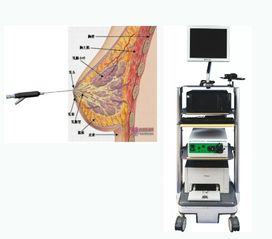 乳腺导管内窥镜 解决乳腺大问题 转载