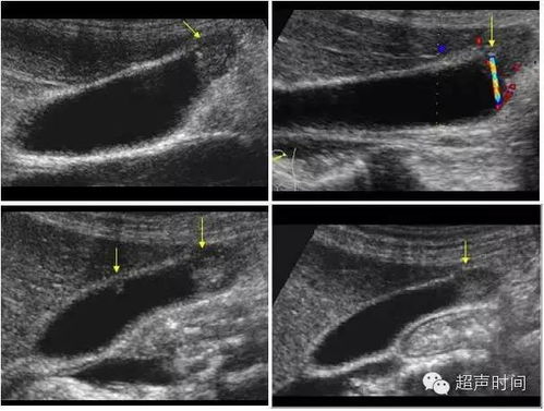 胆囊腺肌增生病的超声表现