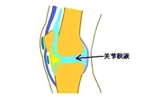 滑膜炎的并发症 膝关节滑膜炎的预防