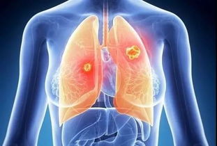 浙江省最新癌情发布 肺癌 女性乳腺癌 甲状腺癌居发病前三,45岁后癌症发病率大增