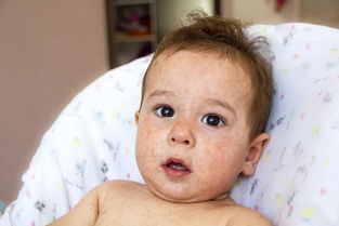 婴儿湿疹不管会怎么样,婴儿湿疹不用治疗会有什么危害