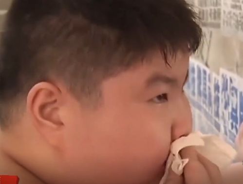 2014年,江西14岁男孩胖到300斤,医生查出罕见病,手术意外连连