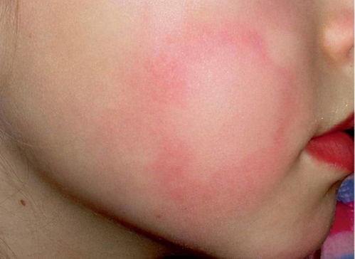 孩子患了荨麻疹,如何区别他是哪种类型