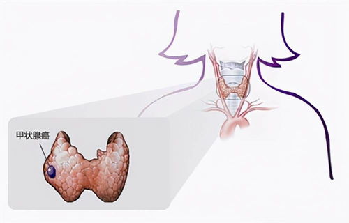 带你认识甲状腺癌四大类