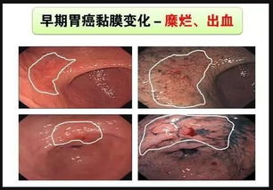 慢性萎缩性胃炎 中医治疗胃癌前病变的优势,常吃一种食物可防癌