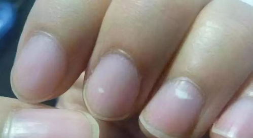 指甲长竖纹 白斑 黑线是疾病征兆 这些实情,现在知道还不晚