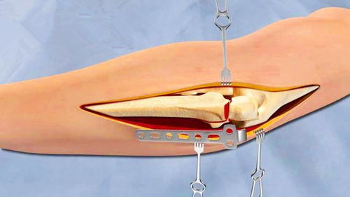 动画展示骨折修复手术过程,网友 我张着嘴看完的 