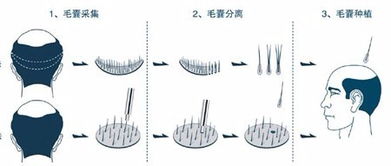 植发多久能长出头发